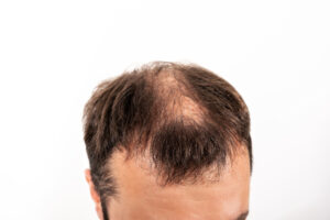 Read more about the article Five Question People Often ask about Alopecia and Hair Loss